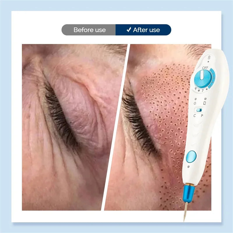 Portable Professional Plasma Pen Machine Removal Mole Wart Removing Pen Acne Treatment Beauty Machine Anti-Wrinkle Skin Lifting